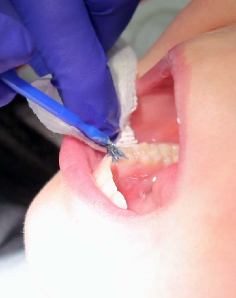 tooth_varnish